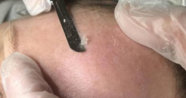 Dermaplaning